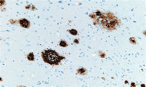 amyloid beta plaque|Amyloid plaques .